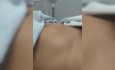 Plastía e-TEP Laparoscopica de Hernia de Spiegel y Hernia Inguinal