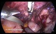Histerectomía total laparoscópica en caso de útero adherido a la pared abdominal anterior