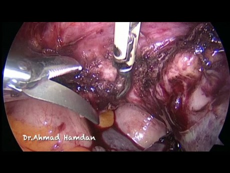 Histerectomía total laparoscópica en caso de útero adherido a la pared abdominal anterior