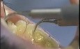 Limpieza de dientes por ultrasonidos