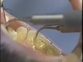 Limpieza de dientes por ultrasonidos