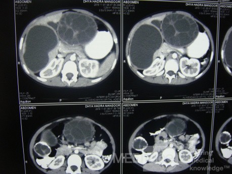 Quiste hidatídico hepático derecho e izquierdo - TC abdominal