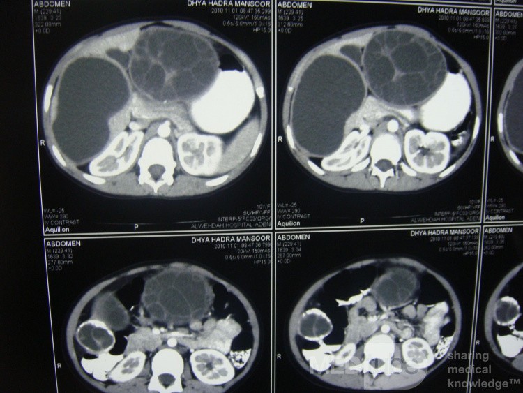 Quiste hidatídico hepático derecho e izquierdo - TC abdominal