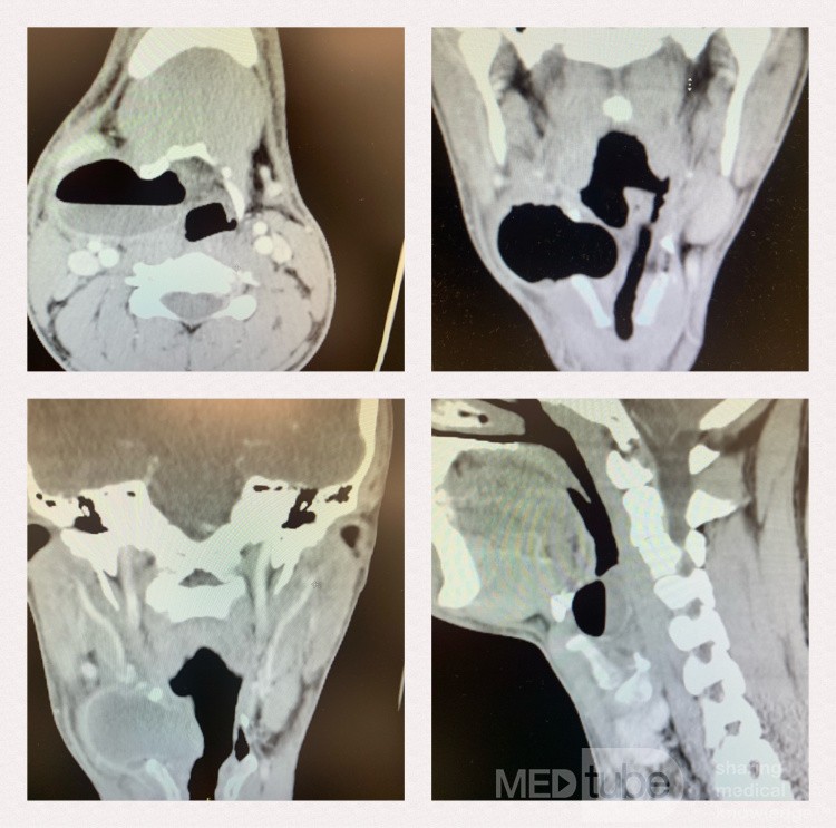 La tomografía computarizada del cuello con contraste mostró laringocele derecho con infección mixta (nivel de aire y líquido)