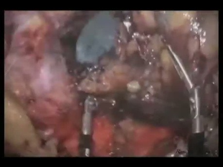 Pancreatectomía distal y esplenectomía LESS