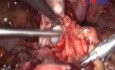 Cuerno Rudimentario/ Endometriosis / Quiste de Chocolate