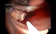 ESD/EMR híbrido con incisión semicircunferencial, sangrado y clips en colon ascendente