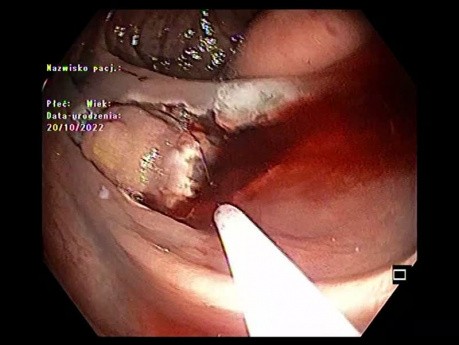 ESD/EMR híbrido con incisión semicircunferencial, sangrado y clips en colon ascendente