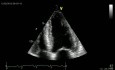 Disfunción ventricular izquierda longitudinal Amiloidosis cardíaca