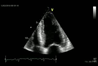 Disfunción ventricular izquierda longitudinal Amiloidosis cardíaca