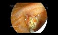 Ampulectomía - Ictericia Obstructiva