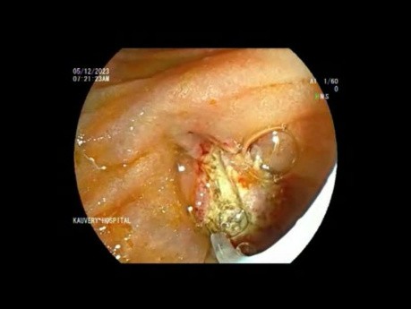 Ampulectomía - Ictericia Obstructiva