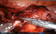 Apendicectomía robótica para apendicitis retrocecal con absceso