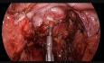 Anastomosis intestinal - aplicación de indocianina verde