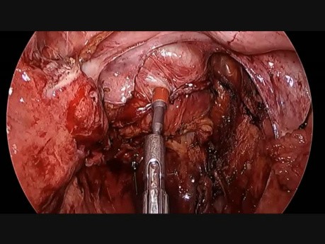 Anastomosis intestinal - aplicación de indocianina verde