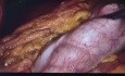 Pancreatectomia corporo caudal por tumor de frantz con tecnica Warshaw