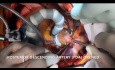Revascularización coronaria sin circulación extracorporal x3