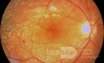 Fotocoagulación panretiniana en la retinopatía diabética proliferativa