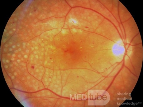 Fotocoagulación panretiniana en la retinopatía diabética proliferativa