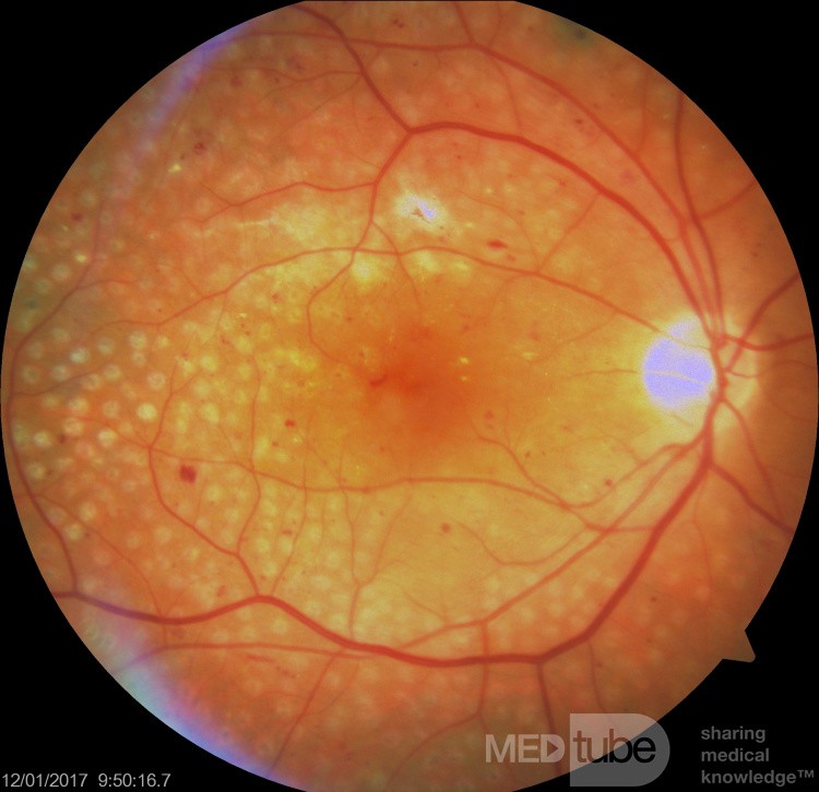 Fotocoagulación panretiniana en la retinopatía diabética proliferativa