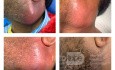 Absceso del cuello izquierdo