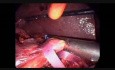 Pancreatoduodenectomía laparoscópica