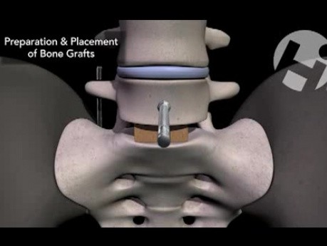 Discectomía cervical anterior y posterior con injerto