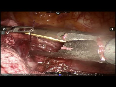 Lobectomía inferior derecha con broncoplastia atípica