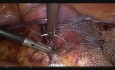 Suspensión transversal de malla para cistocele sintomático