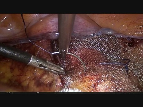Suspensión transversal de malla para cistocele sintomático