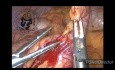 Apendicectomía laparoscópica en la apendicitis aguda
