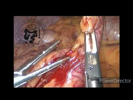 Apendicectomía laparoscópica en la apendicitis aguda