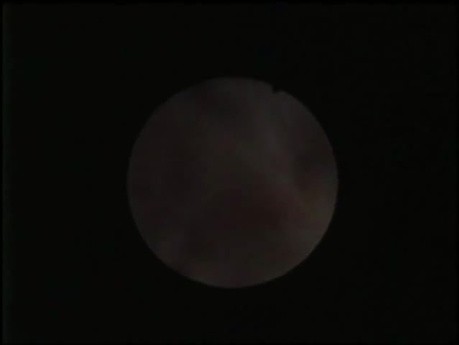Ureteronefroscopia retrógrada