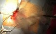 Reparación de hernia femoral