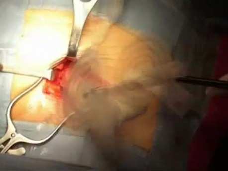 Reparación de hernia femoral