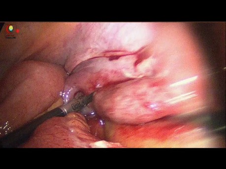 Disección masiva apendicular