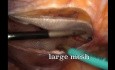 TAPP ventral para hernia umbilical con hernia inguinal directa izquierda concomitante (anotada)