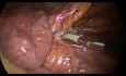 Colectomía laparoscópica subtotal