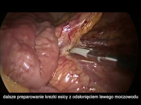 Colectomía laparoscópica subtotal