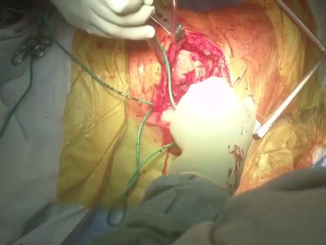 OrthoApproach - Abordaje posterior de la articulación de la cadera | Planos internerviosos | Puntos de referencia quirúrgicos