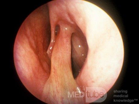 Pólipo nasal de tallo grande y solitario