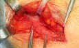 Reparación de hernia inguinal con malla