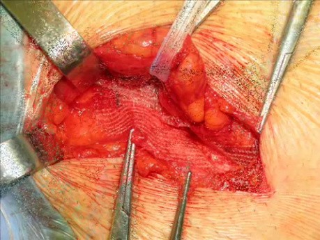 Reparación de hernia inguinal con malla