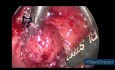 Microcirugía Endoscópica Transanal