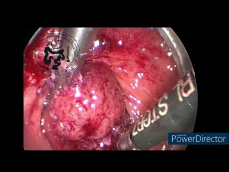 Microcirugía Endoscópica Transanal