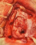 Planificación quirúrgica con neuronavegador en paciente con lesión de masa intracraneal. Glioma de alto grado.