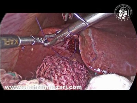 Efecto de la aplicación de sutura sobre el sangrado del lecho hepático durante la colecistectomía laparoscópica