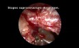 Timpanoplastia PORP endoscópica transcanal para malformación de la cadena osicular