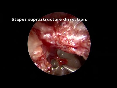 Timpanoplastia PORP endoscópica transcanal para malformación de la cadena osicular