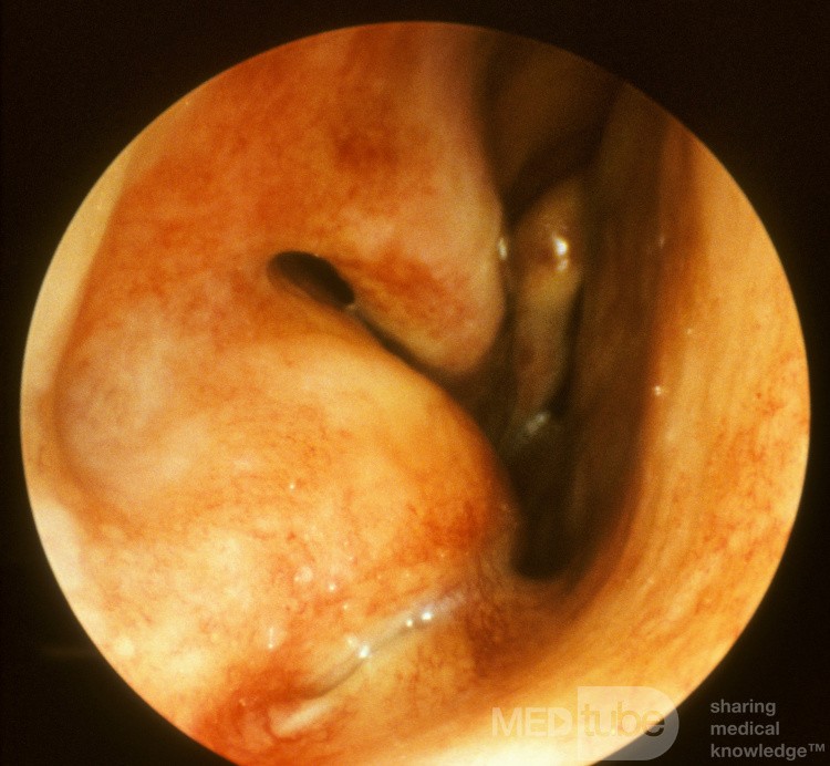 Mucocele del seno maxilar